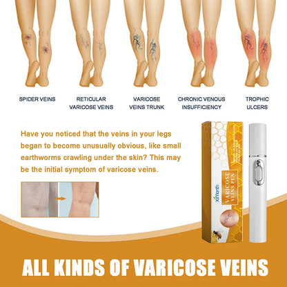 Favolux™ Lampshade Therapy Varicose Veins Legs Effective Relief Of Dilated Vasculitis Phlebitis Health Improved Blood Circulation